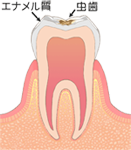 Ｃ１：歯の表層（エナメル質）の虫歯