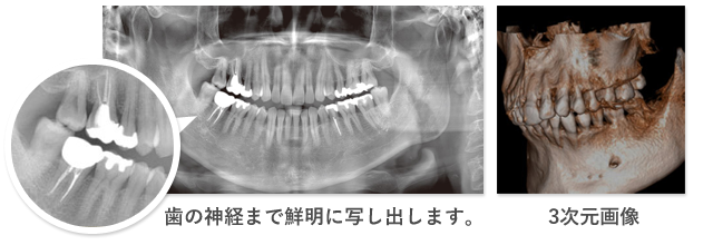 歯科用CTモリタベラビューエポック