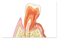 STEP4：歯周病検査・歯周病治療