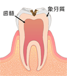 C2:歯の中(象牙質)の虫歯