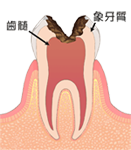 C3:神経まで達した虫歯
