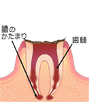 C4:歯の根まで達した虫歯
