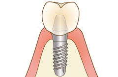 STEP6:上部構造装着