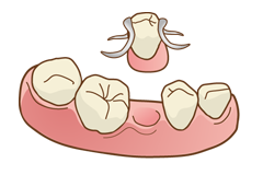 入れ歯・義歯