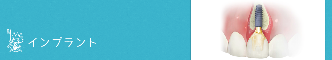 インプラント