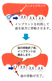 インプラント矯正