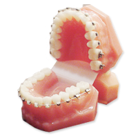 一般的な矯正治療(ワイヤー矯正)