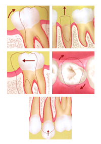部分矯正(MTM矯正)