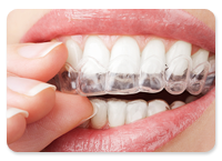 マウスピース矯正:インビザライン