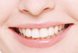 ホワイトニング