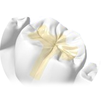 インレー(詰め物)